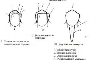 Когда оправдано протезирование комбинированными коронками