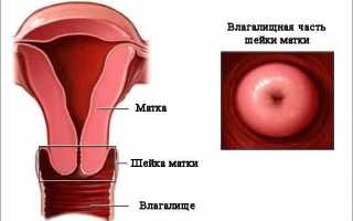 Что называют плоскоклеточной папилломой шейки матки