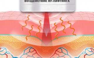 Радиочастотный лифтинг: виды, показания, результат