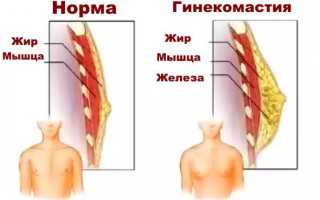Пластика груди в лечении гинекомастии у мужчин – операция по удалению гинекомастии